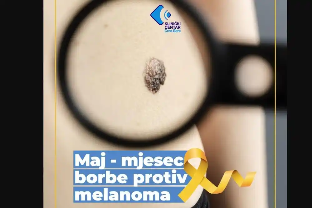 KCCG: Mjesec borbe protiv melanoma kože – preventivni pregledi bez uputa i zakazivanja