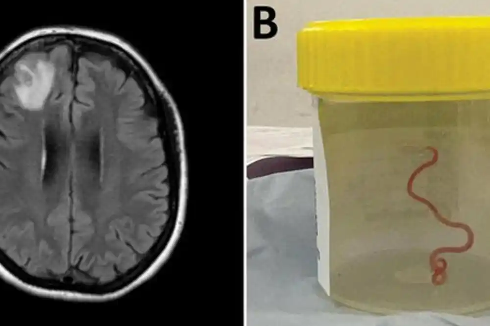 Ljekari pronašli živog crva u mozgu žene tokom operacije
