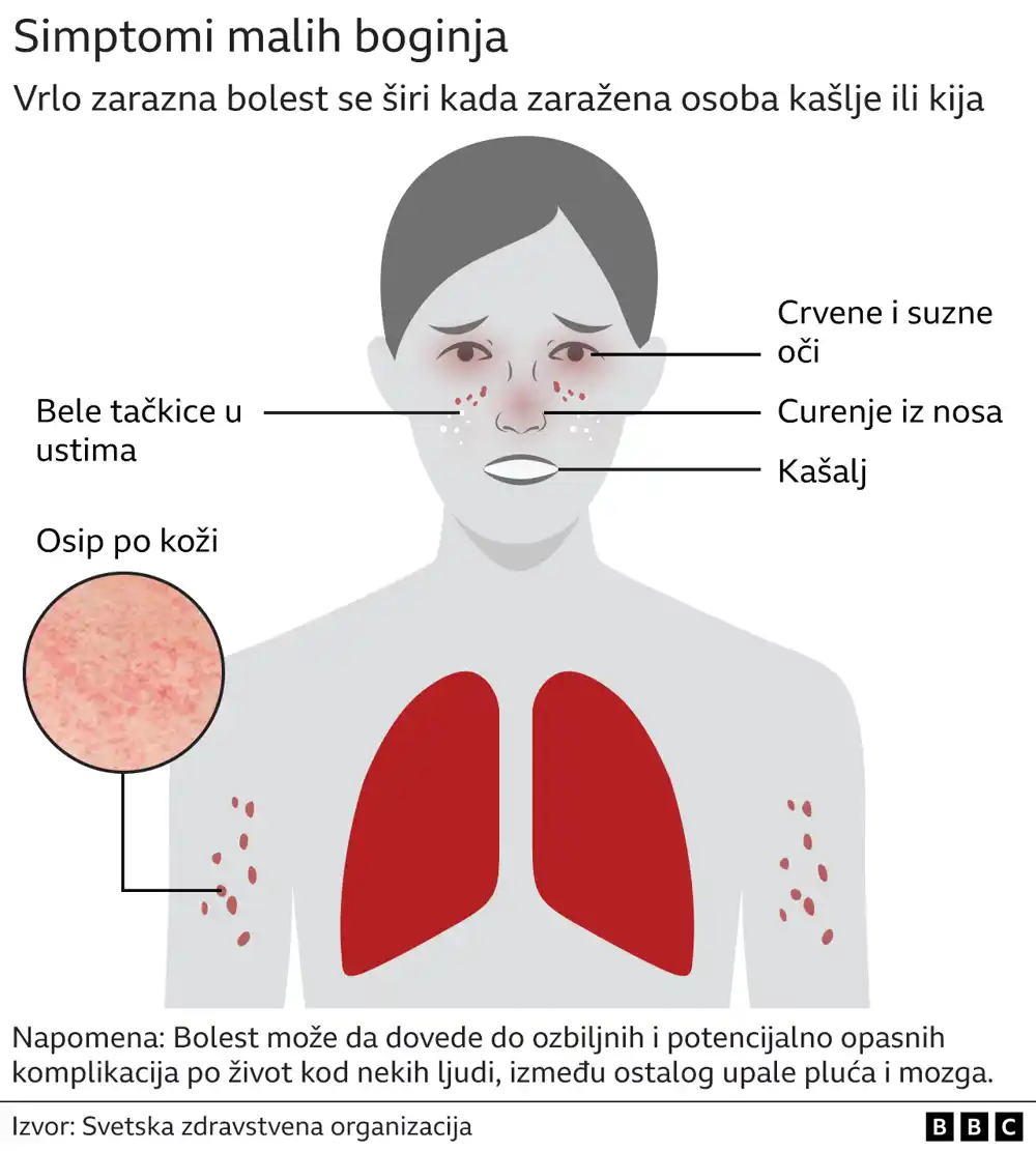 Male boginje: Koji su simptomi i kako spriječiti zarazu