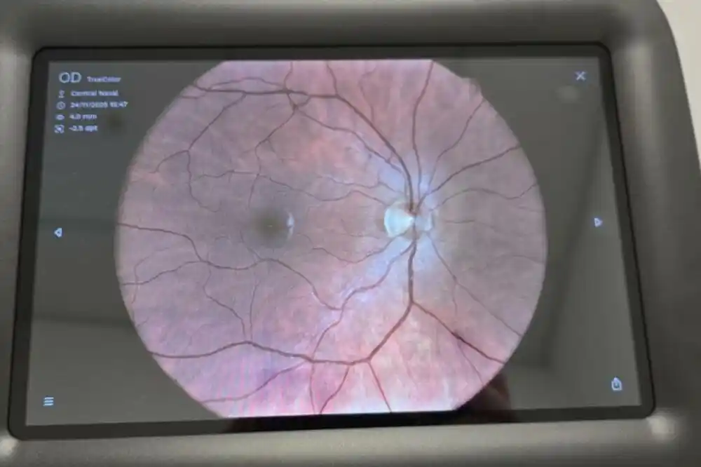 Ministarstvo zdravlja pokreće pilot-projekat za bržu i dostupniju zaštitu vida