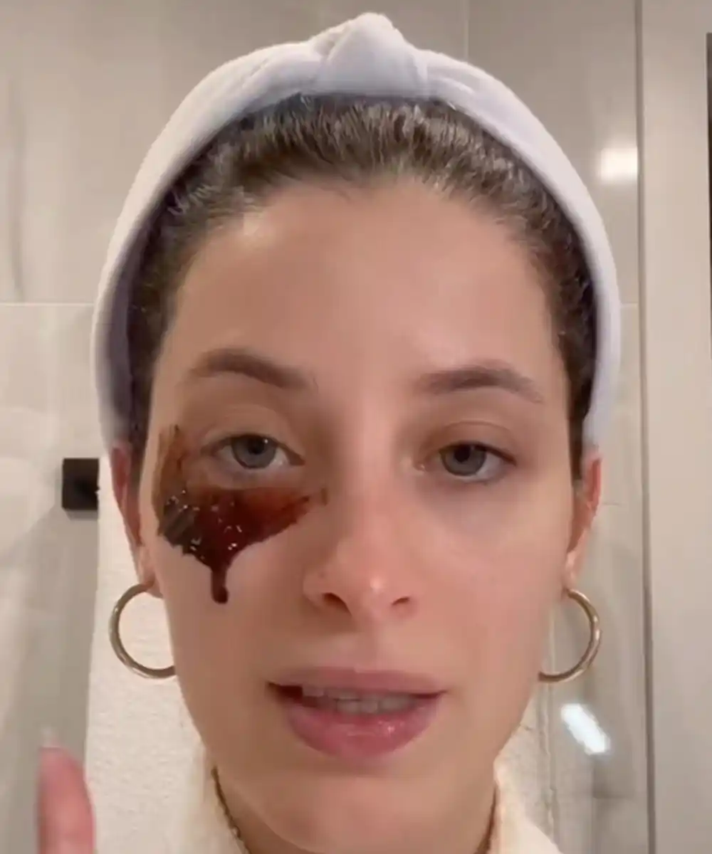 Kesice ispod očiju nestaju uz ove prirodne tretmane