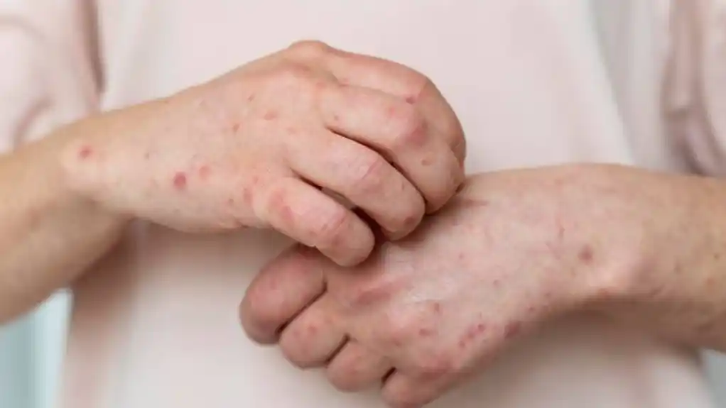 Morbile se ponovo šire u Bugarskoj: Potvrđena 534 slučaja