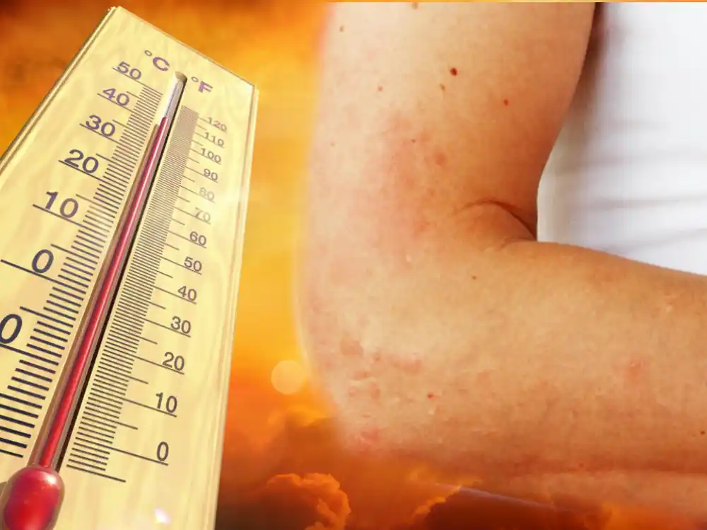 Alergija na sunce može se javiti i u odraslom dobu: Zašto polimorfna svjetlosna erupcija izbija tek danima kasnije i kako spriječiti osip