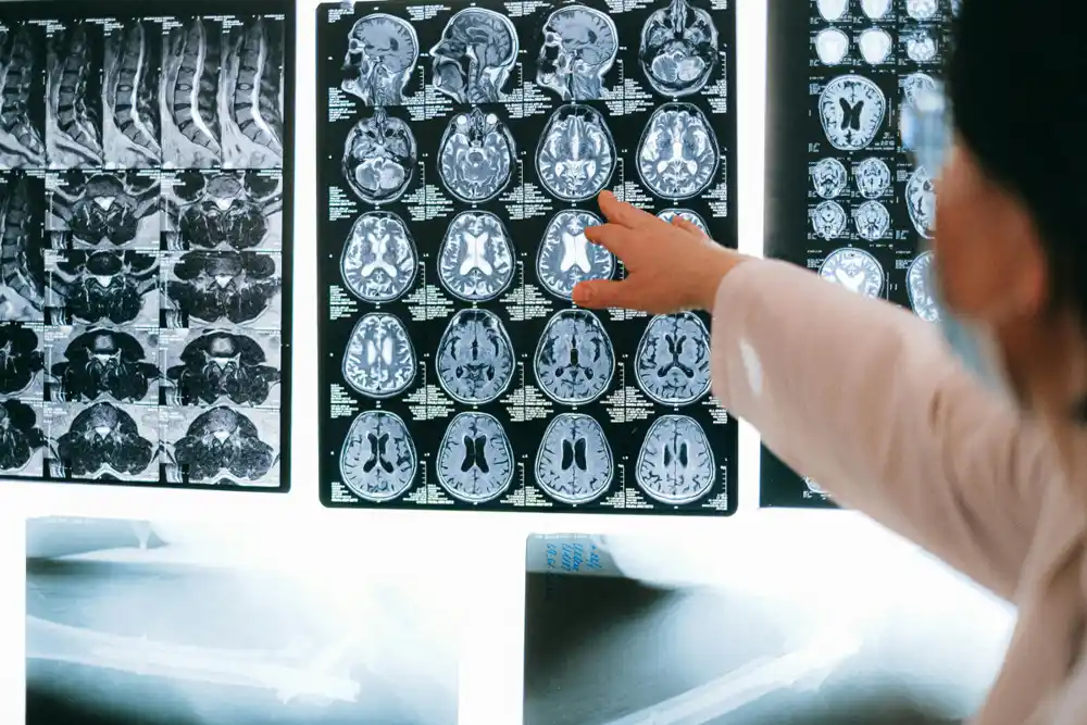 Prvi put na svijetu: Vještačka inteligencija pomogla hirurzima da uklone tumor na mozgu