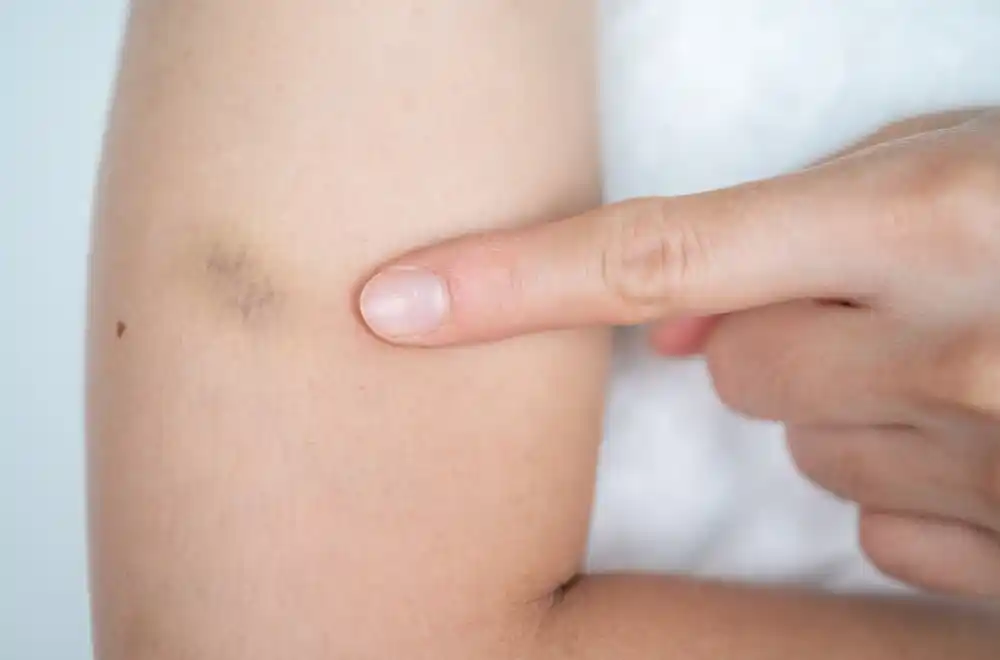 Modrice vam se pojavljuju bez razloga? Ovo su znakovi koje ne smijete da ignorišete